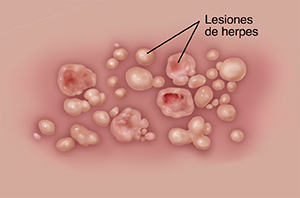 Genital Herpes Health Encyclopedia University Of Rochester Medical