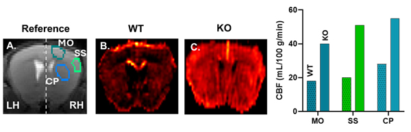 Arterial Spin Labeling (ASL) Perfusion MRI