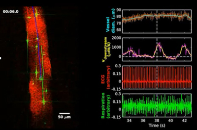 cervical lymphatic vessels in Alzheimer’s disease