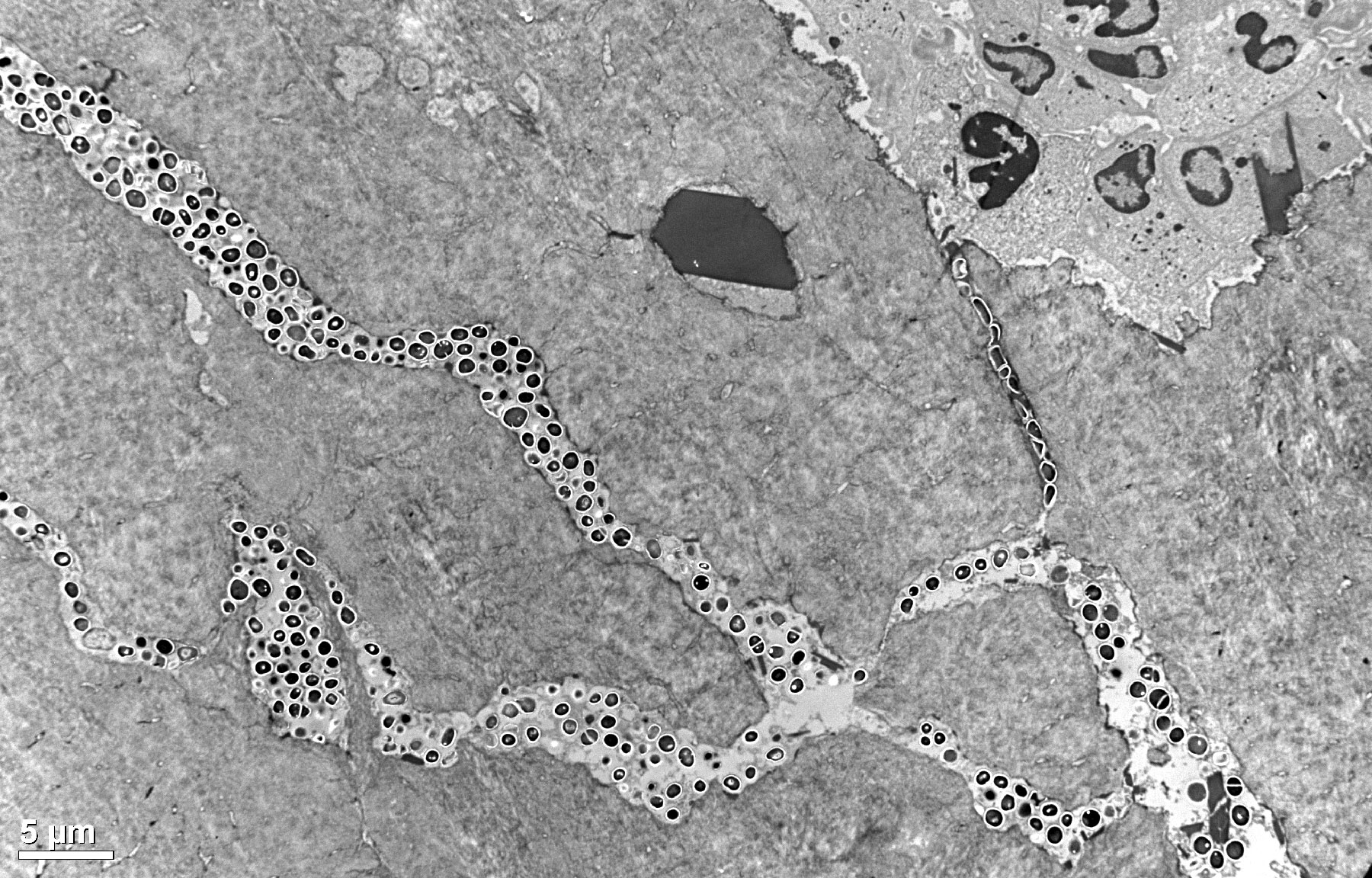 TEM of MRSA in Bone Fissure and White Blood Cells Unable to Phagocytize