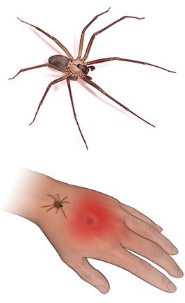 Spider Bites - Health Encyclopedia - University of Rochester Medical Center