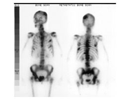 bone cancer metastases metastasis bones spreads when rochester encyclopedia diagnose doctors find lecture radiology notes
