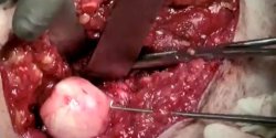 FAI Hip Repleacement