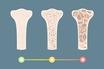 UR Scientists Working to Crack Enduring Mystery of Bone Loss, Regeneration